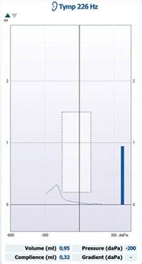 tympanogram a b c|Understanding Tympanometry & Tympanogram .